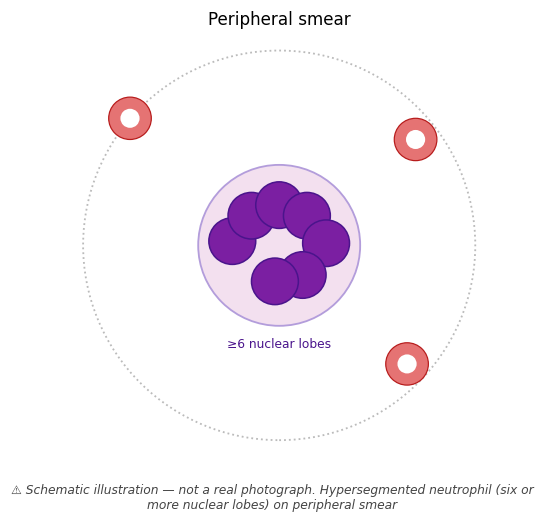 Hypersegmented neutrophil (six or more nuclear lobes) on peripheral smear