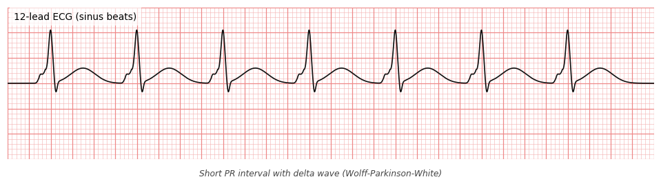 Short PR interval with delta wave (Wolff-Parkinson-White)