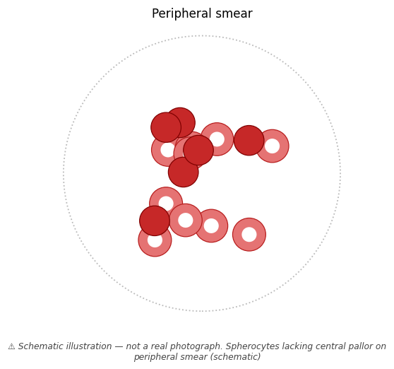 Spherocytes lacking central pallor on peripheral smear (schematic)