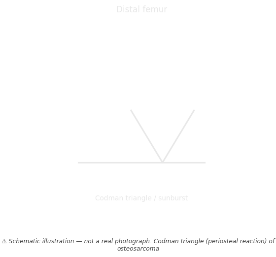 Codman triangle (periosteal reaction) of osteosarcoma