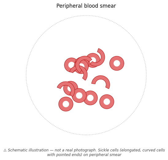 Sickle cells (elongated, curved cells with pointed ends) on peripheral smear